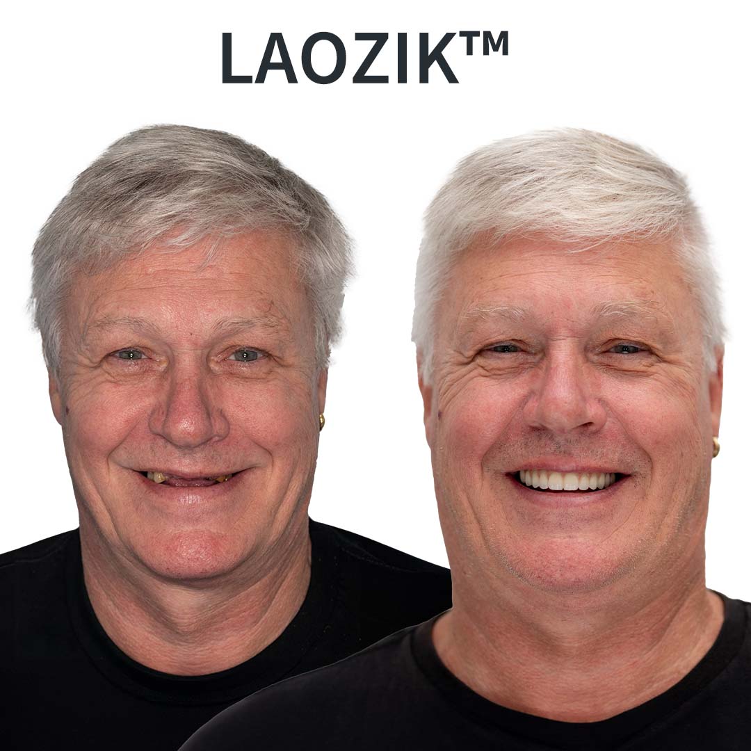 Proteze dentare funcționale LAOZIK™ cu ajustare adaptabilă – Fabricate în SUA și certificate de FDA